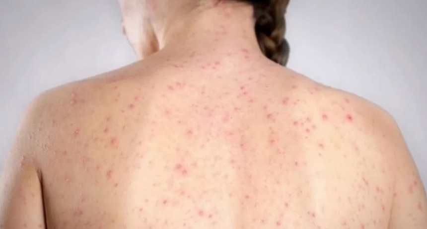Sarampion: Desesperado Pedido del Ministro de Salud por el brote de sarampi&oacute;n
