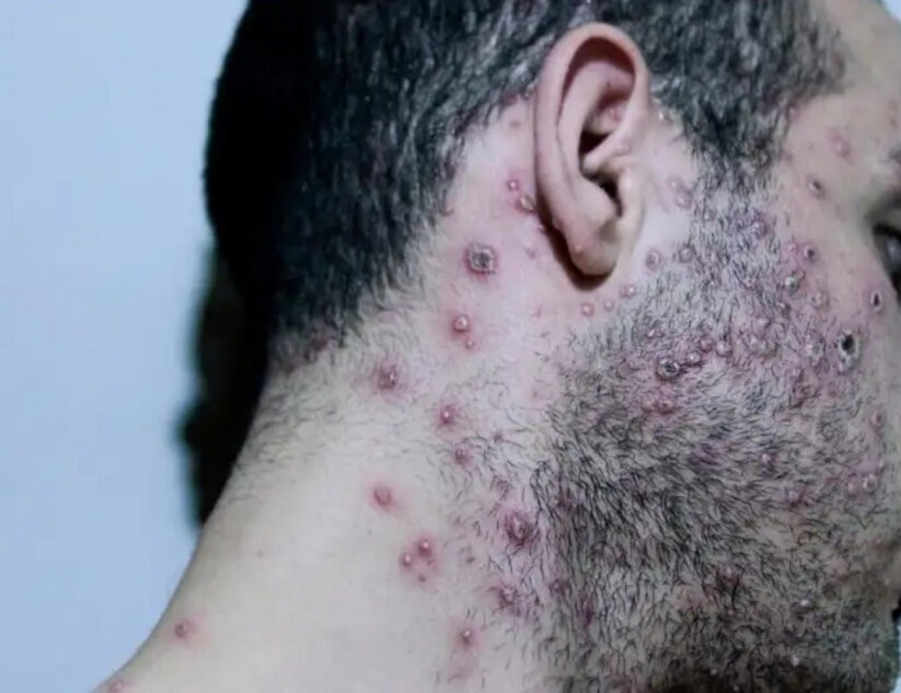 Viruela del mono: un especialista aclar&oacute; que el brote es "prevenible" y explic&oacute; c&oacute;mo actuar